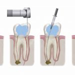 نحوه عصب کشی یا روت کانال دندان در چند مرحله