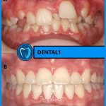 درمان دندان اضافه قبل بعد