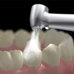 سوال و جواب دربارهی پر کردن دندان و ترمیم