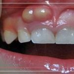 علت آبسه دندان چیست ؟