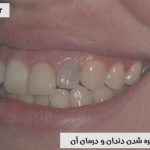 علت تیره شدن دندان و درمان آن