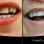 قبل و بعد ونیر کامپوزیت بعد از کامپوزیت چه شکلی میشوم دندانپزشکی زیبایی دکتر سید محسنی