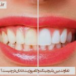 تفاوت بین بلیچینگ و کامپوزیت دندان در چیست ؟