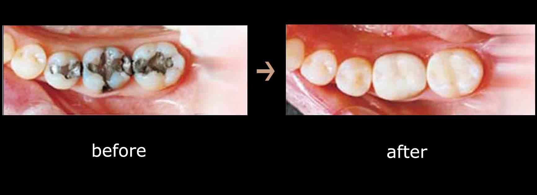 عکس قبل و بعد پر کردن دندان