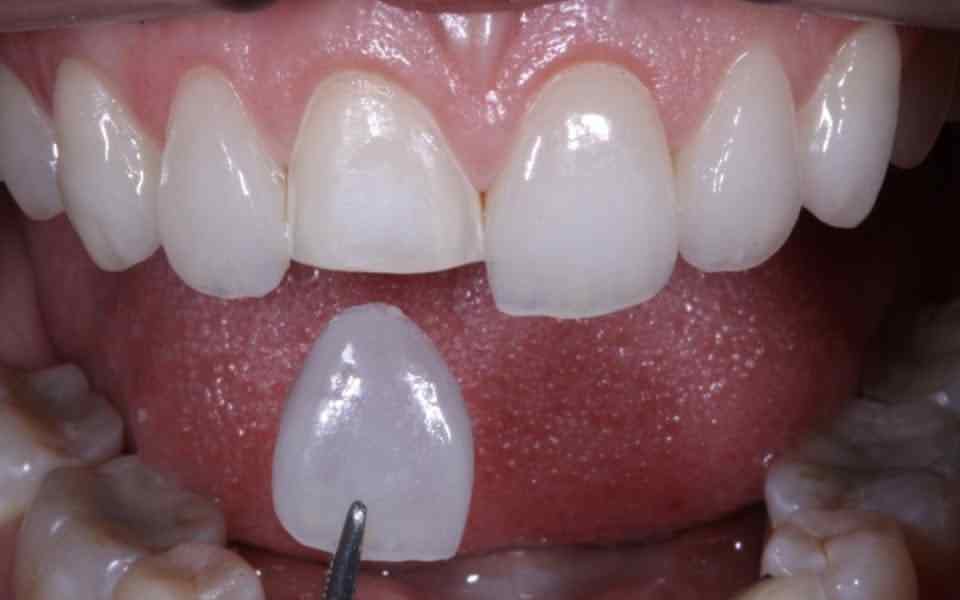 جایگذاری لمینت ساخته شده روی دندان