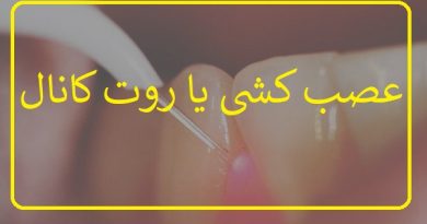 عصب کشی یا روت کانال