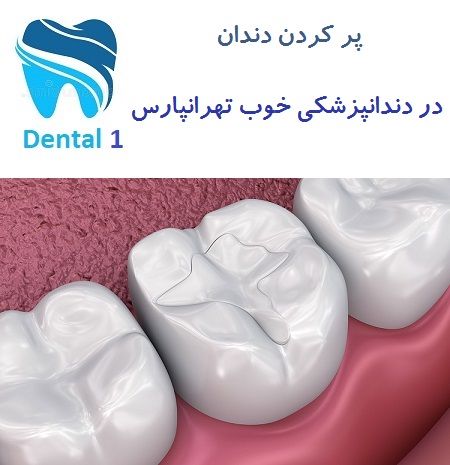پر کردن دندان در دندانپزشکی خوب تهرانپارس