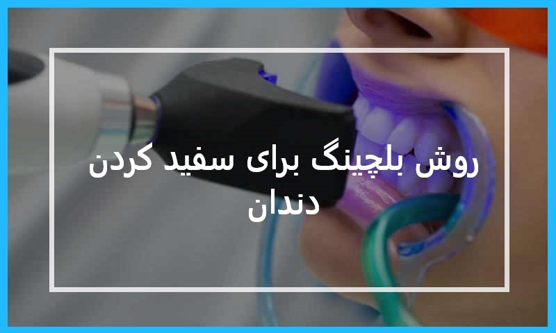بلچینگ