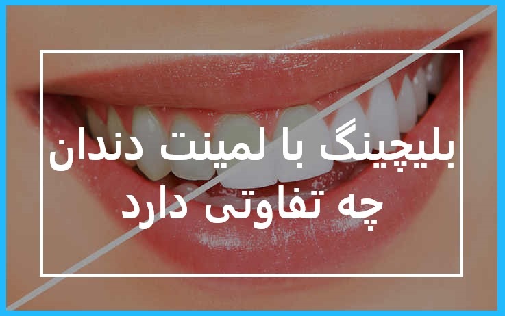 جرم گیری و بلچینگ