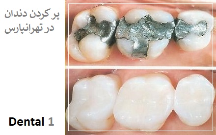 پر کردن دندان در تهرانپارس