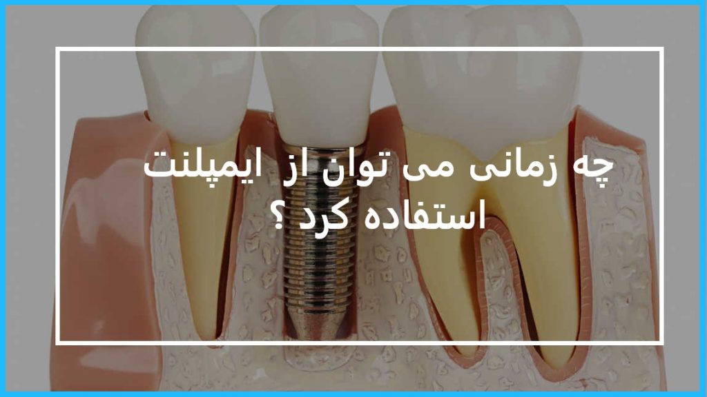 راه حل جایگزین ایمپلنت