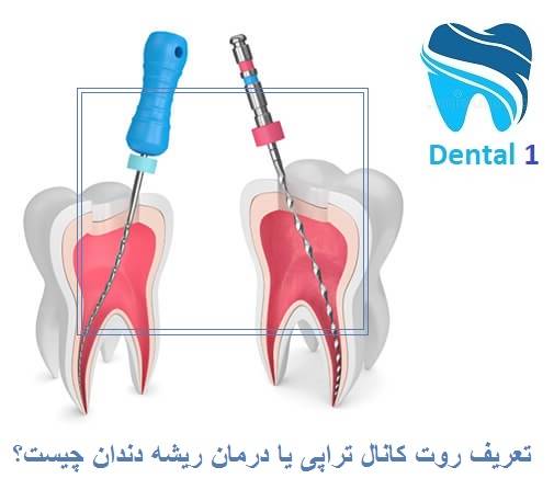 تعریف روت کانال تراپی یا درمان ریشه دندان چیست؟