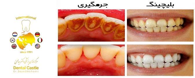 جرمگیری و بلیچینگ در شرق تهران