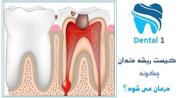 کیست ریشه دندان چگونه درمان می شود؟
