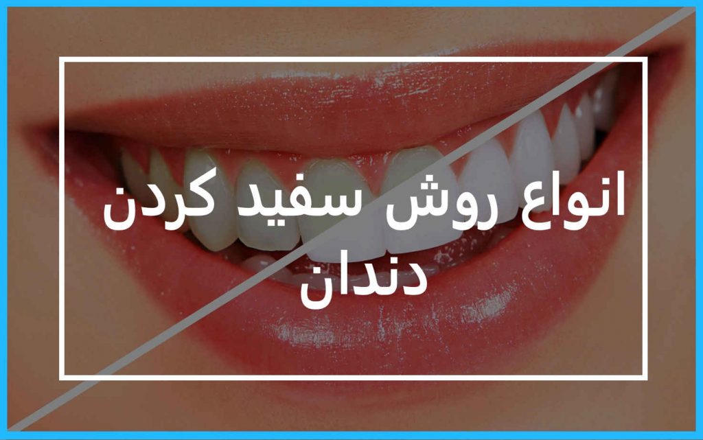 روش سفید کردن دندان