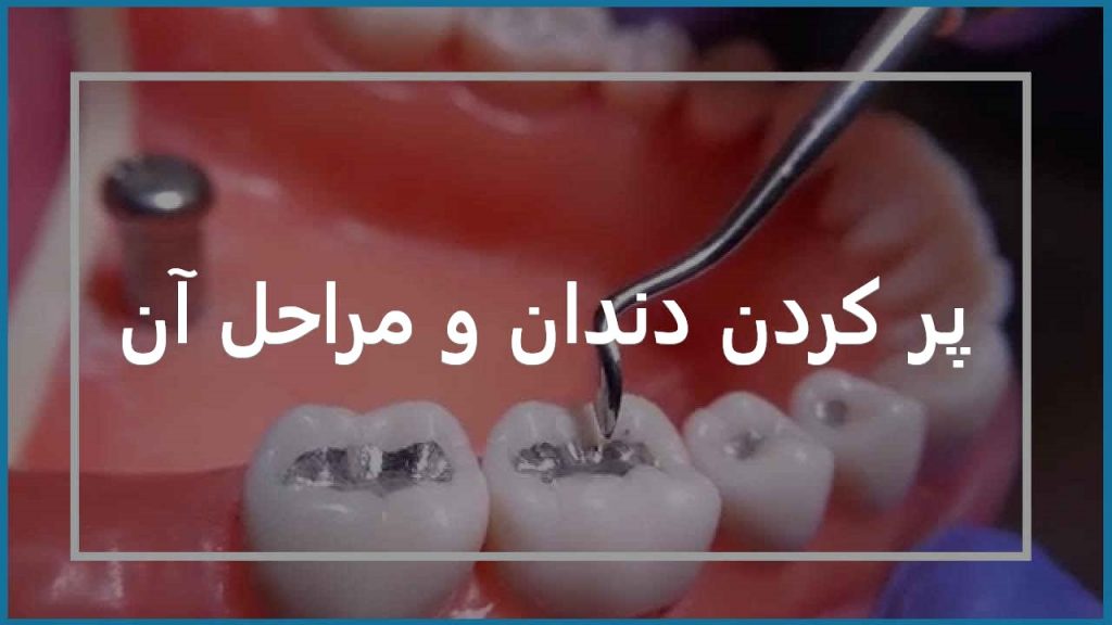 پر کردن دندان