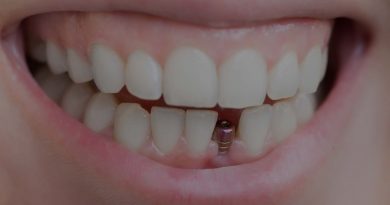 ایمپلنت و کاشت دندان