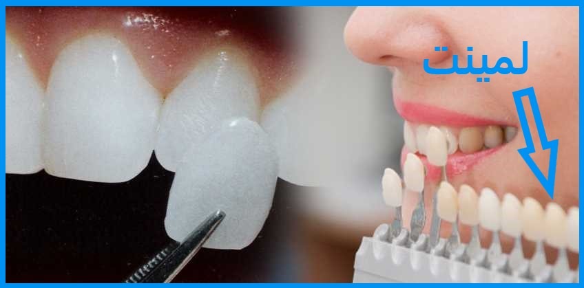 روش سفید کردن دندان و لمینت در کلینیک دندانپزشکی سعادت اباد انجام میشود