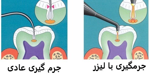 کاربرد لیزر در دندانپزشکی