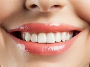 زنی در حال لبخند با دندان های سفید