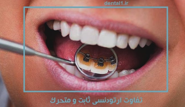 تفاوت ارتودنسی ثابت و متحرک