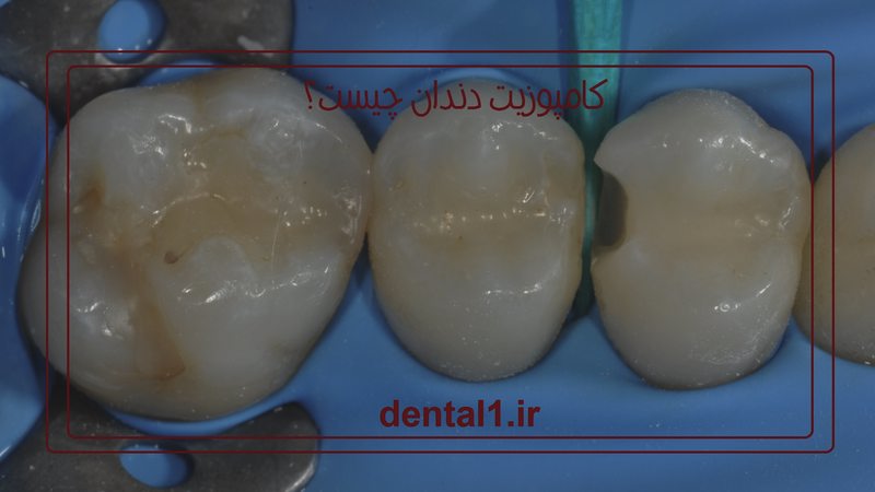 مراحل کامپوزیت دندان