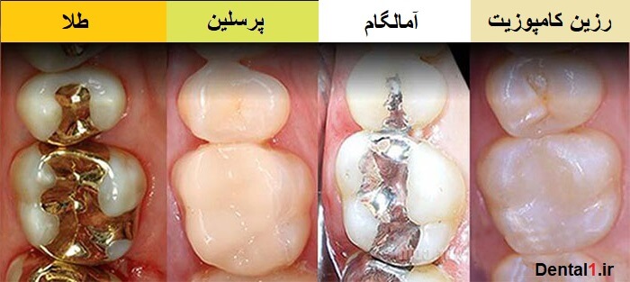 پر کردن دندان در کلینیک دندانپزشکی شبانه روزی در تهران