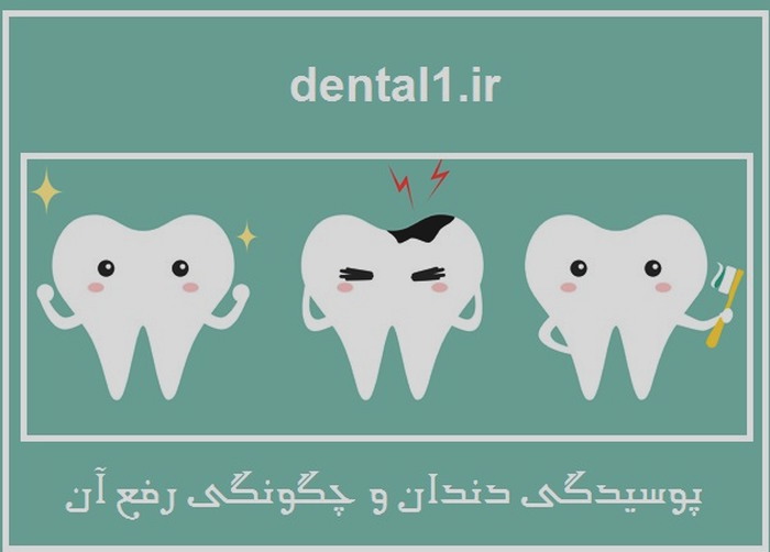 پوسیدگی دندان و چگونگی رفع آن