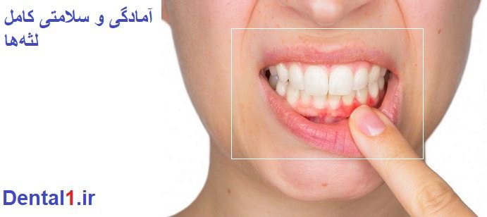 چه شرایطی برای ایمپلنت دندان حائز اهمیت است؟