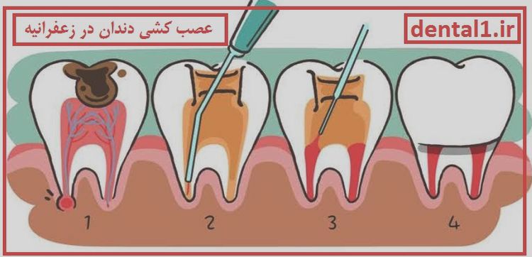 عصب کشی در زعفرانیه