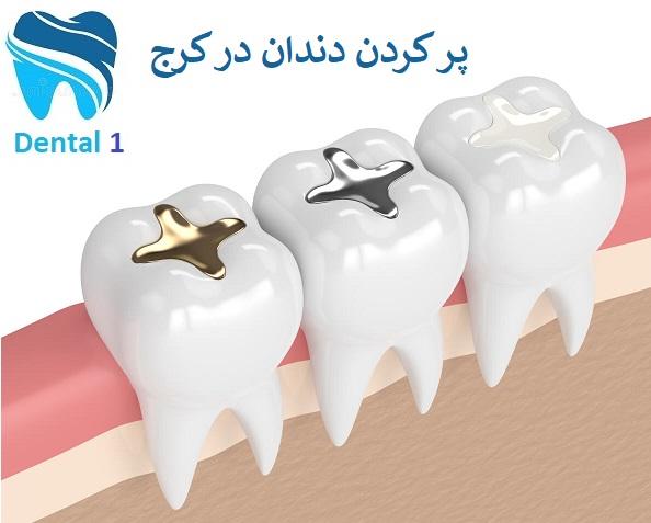  پرکردن دندان در کرج