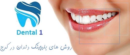 روش های بلیچینگ دندان در کرج