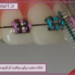 مراقبت های لازم از ارتودنسی و سوالات رایج در مورد ارتودنسی دندان
