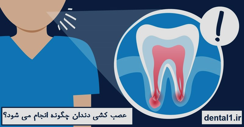 عصب کشی دندان چگونه انجام میشود ؟