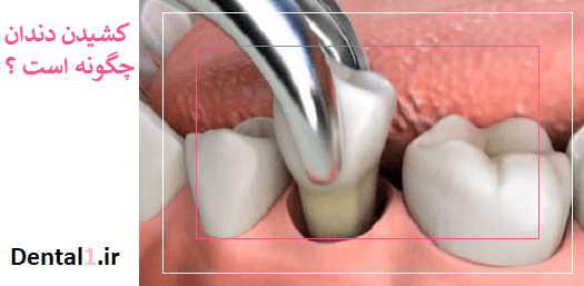 نحوه ی کشیدن دندان توسط دندانپزشک