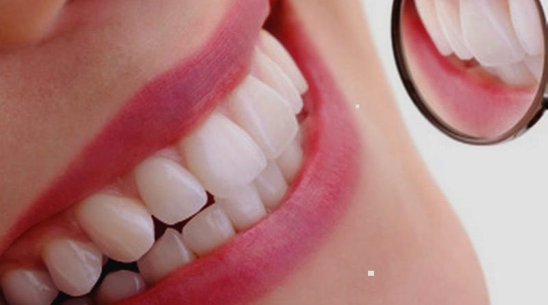عوارض و خطرات بلیچینگ دندان