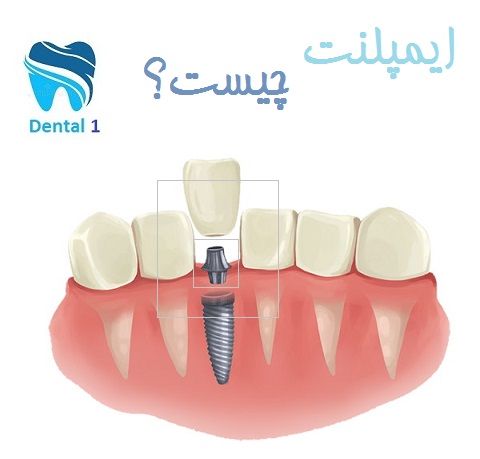 ایمپلنت چیست؟