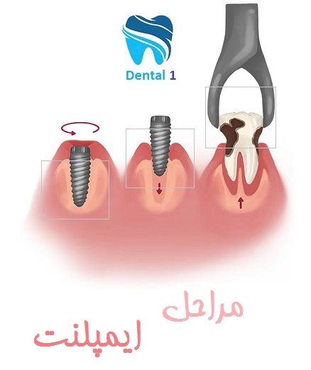 مراحل ایمپلنت