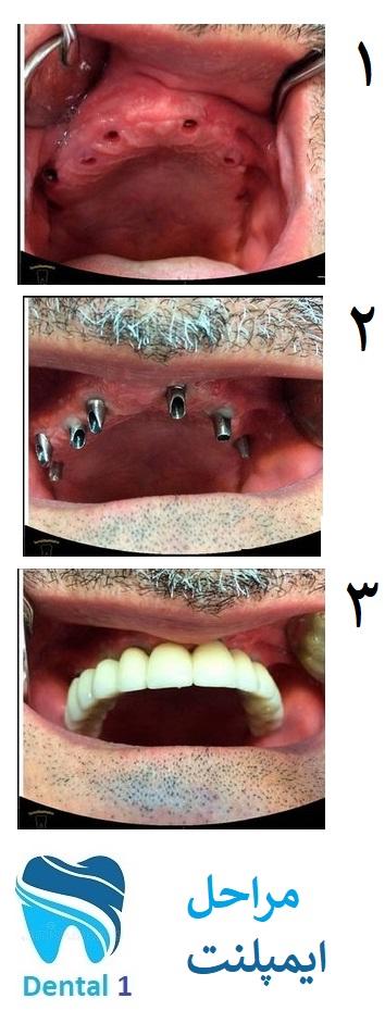 مراحل ایمپلنت