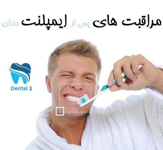 مراقبت های پس از ایمپلنت دندان