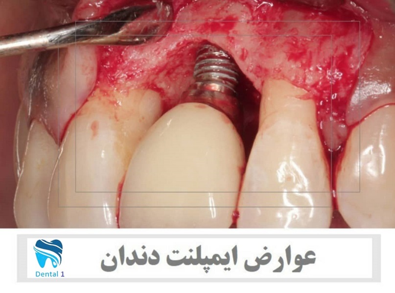 عوارض ایمپلنت دندان چیست؟