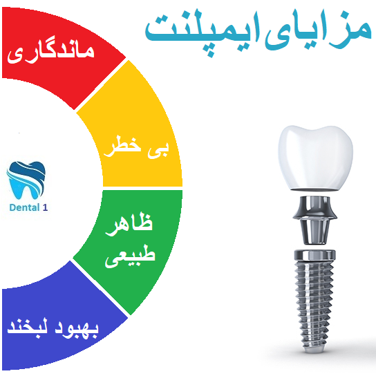 مزایای ایمپلنت