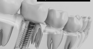 تعداد جلسات لازم برای ایمپلنت