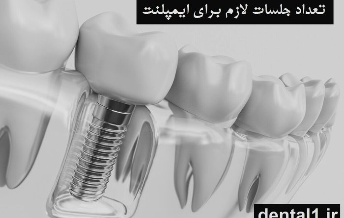 تعداد جلسات لازم برای ایمپلنت