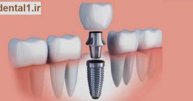 ایمپلنت یک روزه فوری
