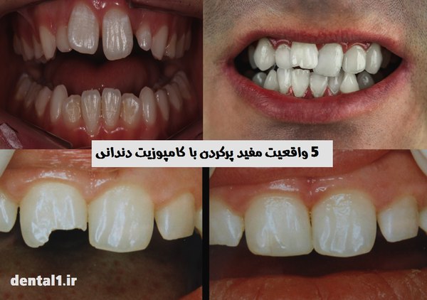 بهترین مرکز کامپوزیت دندان در تهرانپارس