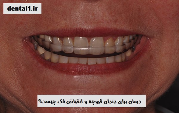 دندان قروچه و درمان آن
