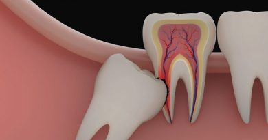 دندان عقل نهفته چیست