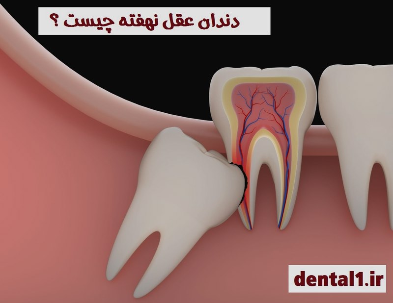 دندان عقل نهفته چیست