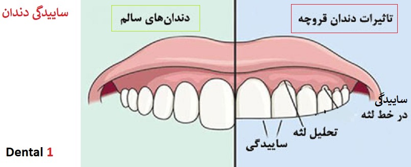 ساییدگی مینای دندان و راه درمان